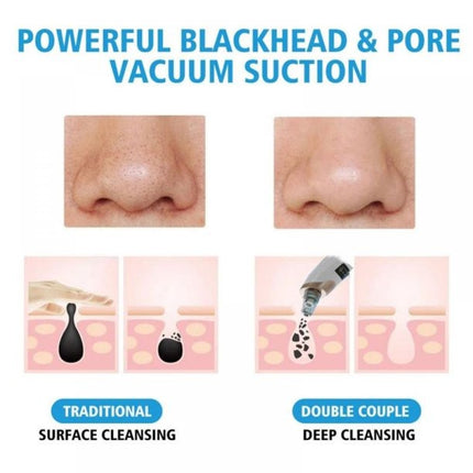 Electric Suction Blackhead